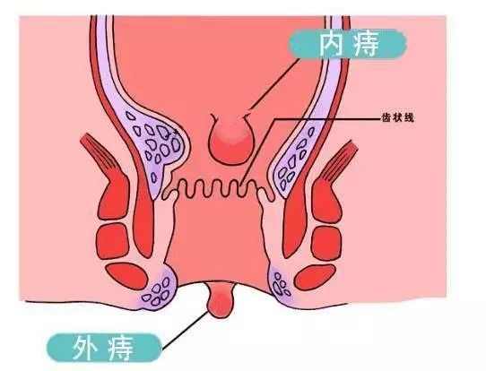 所以痔疮能引起慢性前列腺炎.