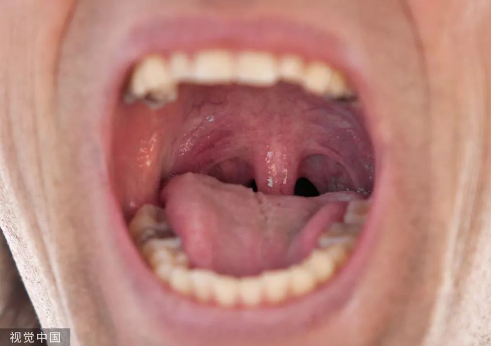 有资料显示,扁桃体癌是一种比较罕见的恶性肿瘤,指起源于口咽两侧壁