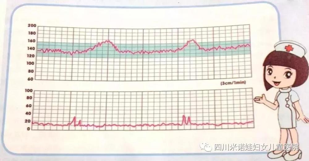 胎心电子监护是利用超声波的原理对胎儿在宫内的情况进行监测,对胎儿