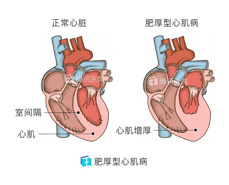 肥厚型心肌病是一种左心室壁异常增厚的病变,往往和遗传有关,由于泵血