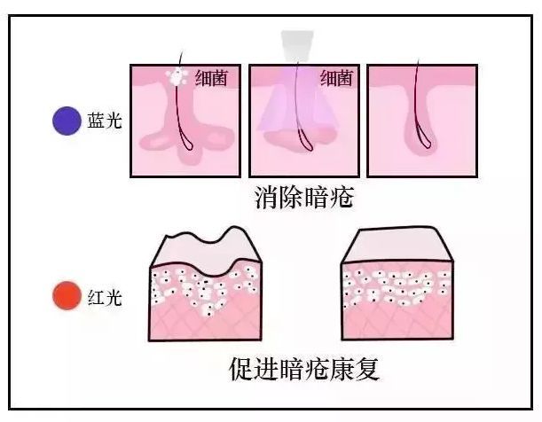 痤疮的形成原理示意图_痤疮形成阶段示意图(2)