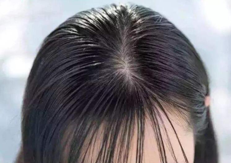 头发油腻瘙痒,其实是头皮有6个异常,3方法恢复三天一洗