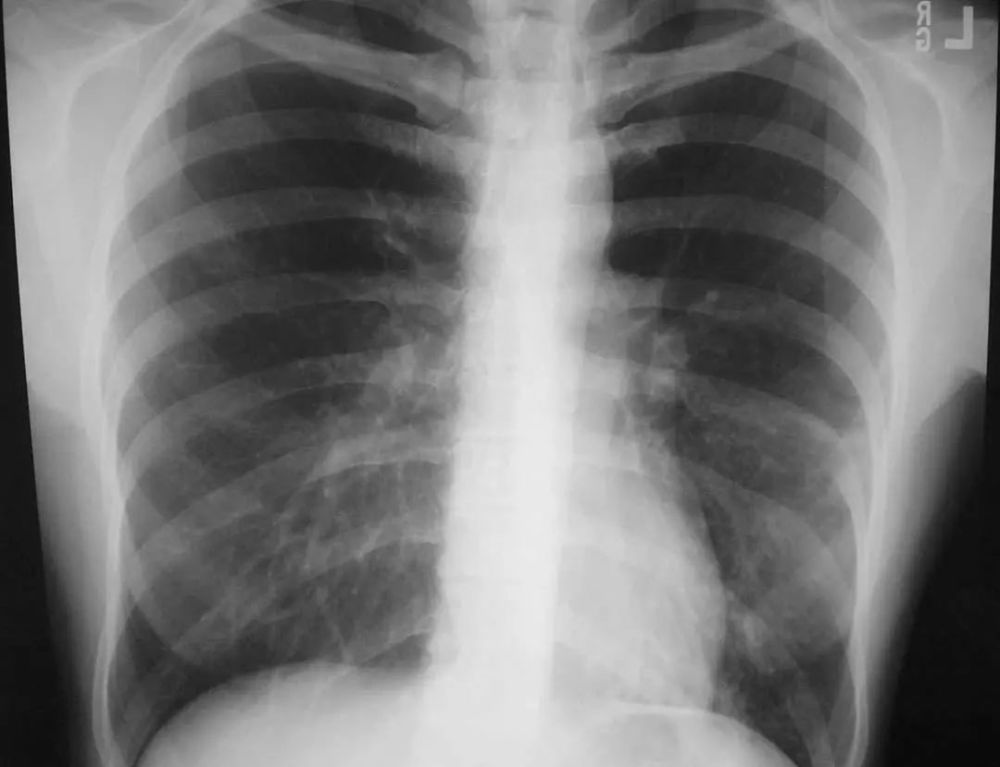 5 40岁肺炎衣原体患者.胸片显示右上,中,下叶多灶性斑片状实变.