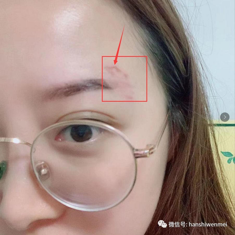 纹眉敷麻后眉毛红肿,好几天不消散怎处理?