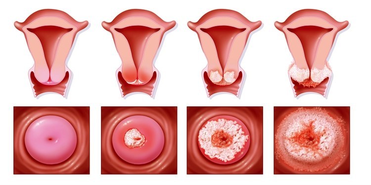 宫颈癌的演变过程./ quanjing