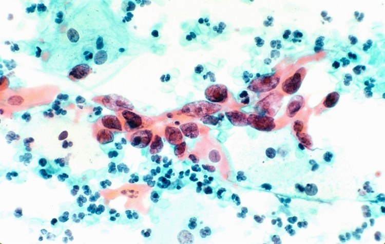 光学显微镜下的宫颈癌细胞./ quanjing