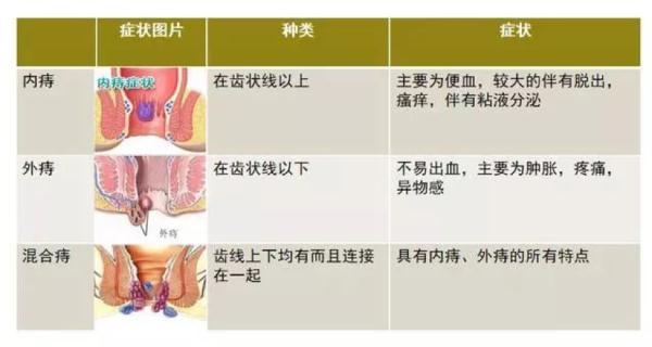 5%~10%需要手术治疗 需要综合考虑痔疮的分类及表现症状,首先要遵循2