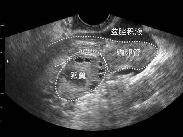 盆腔积液的超声图像