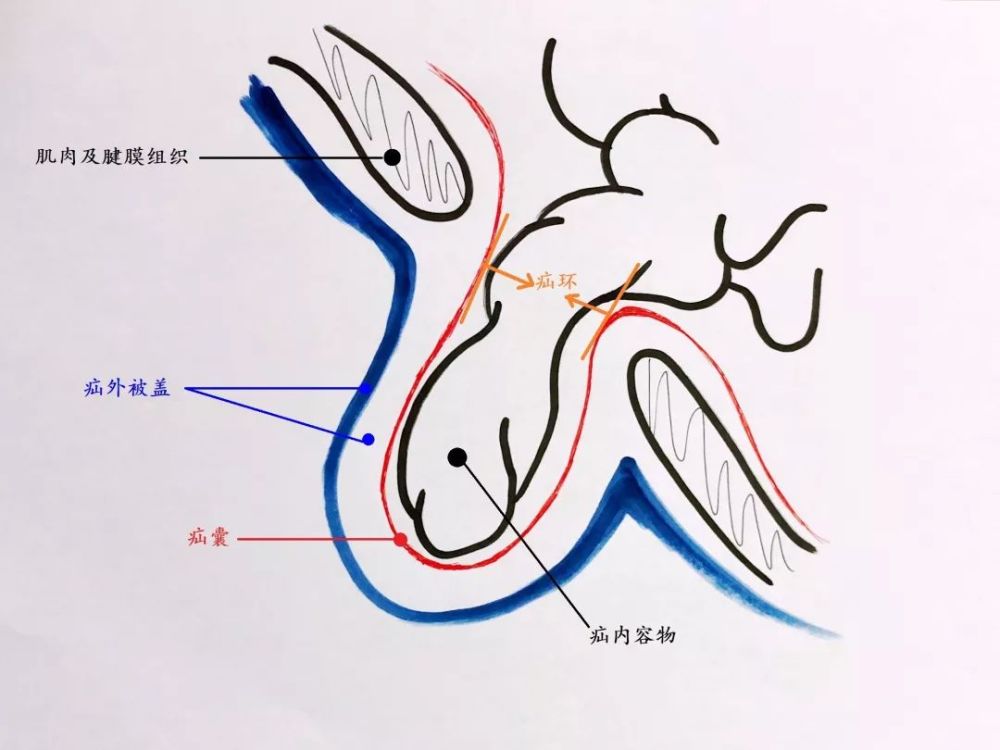 小儿外科医生图解腹外疝上