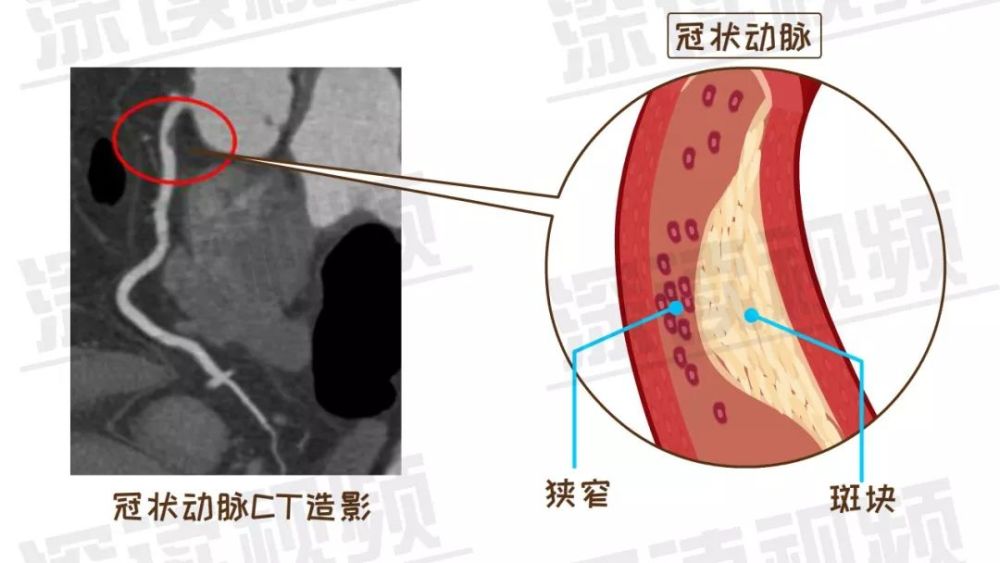 搭脉怎么判断早搏_早搏心电图怎么看图解(3)