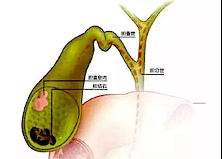 胆囊息肉是否要切除?