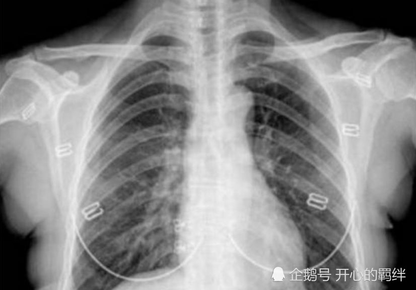 为何女孩都害怕做"胸透"呢?医生都能看到什么?00后趁早了解