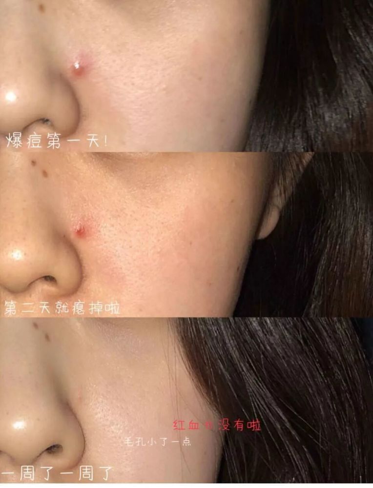 不论是 改善粉刺, 调理角质,还是 对付红肿痘痘效果都非常强大!