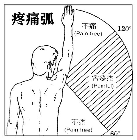 肩袖损伤"垂臂试验阳性"的推拿,艾灸,运动方法.滕州徐长芳