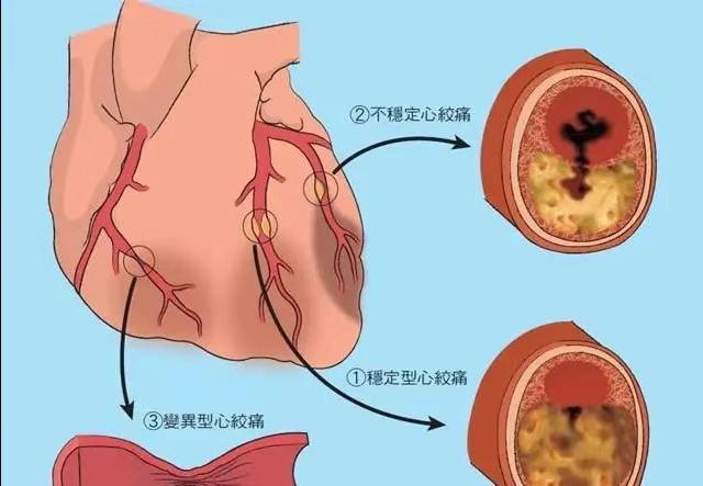 31岁,心脏血管长在了心脏肌肉里面,导致了心梗,叫作心肌桥