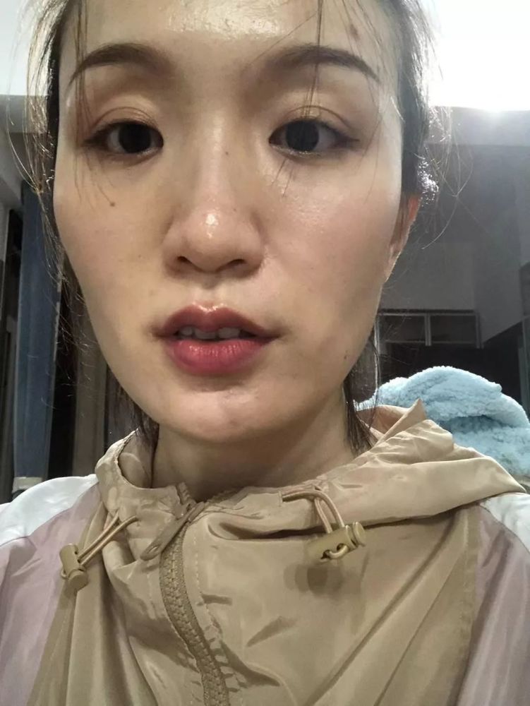 这两张是今年打完第二针,开始出现脸歪和明显的太阳穴凹陷了,有点后悔