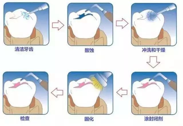 在上面涂上一种容易固化的光滑的牙科材料(即窝沟封闭剂),在牙齿表面