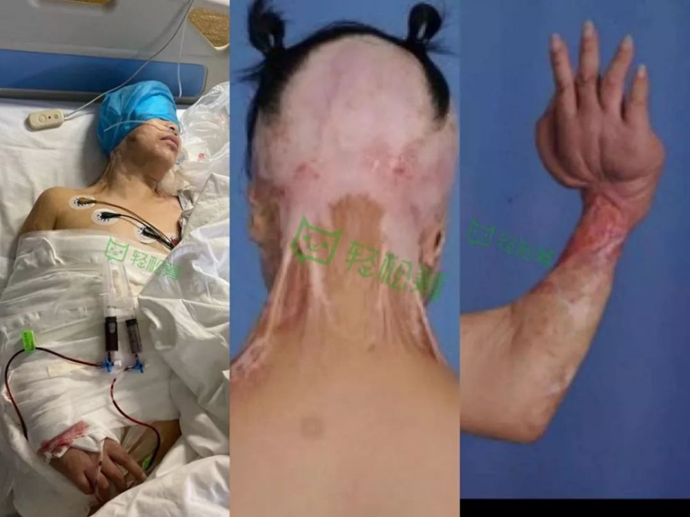 陆河一妇女全身烧伤面目全非.