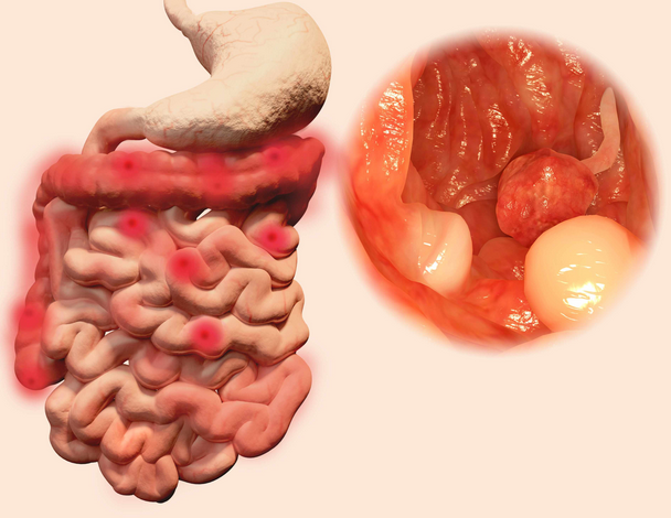 早期肠癌症状不明显!医生劝告:若出现5种现象,或是肠癌已上身