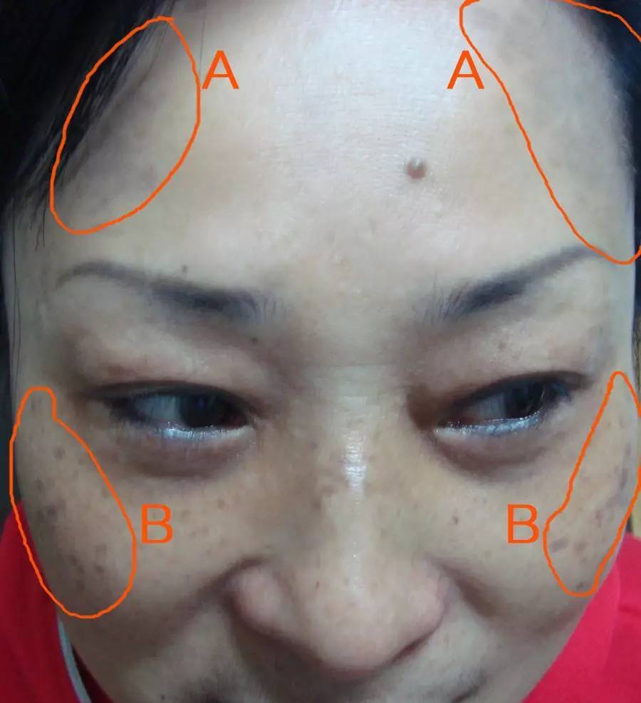 a:片状真皮斑 b:颗粒状真皮斑