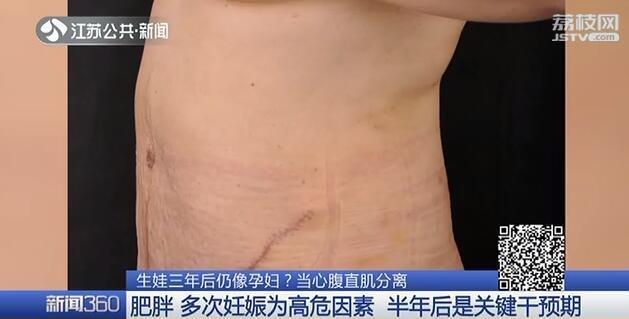 二胎妈妈坚持健身肚子竟越减越大 生娃三年后仍像孕妇