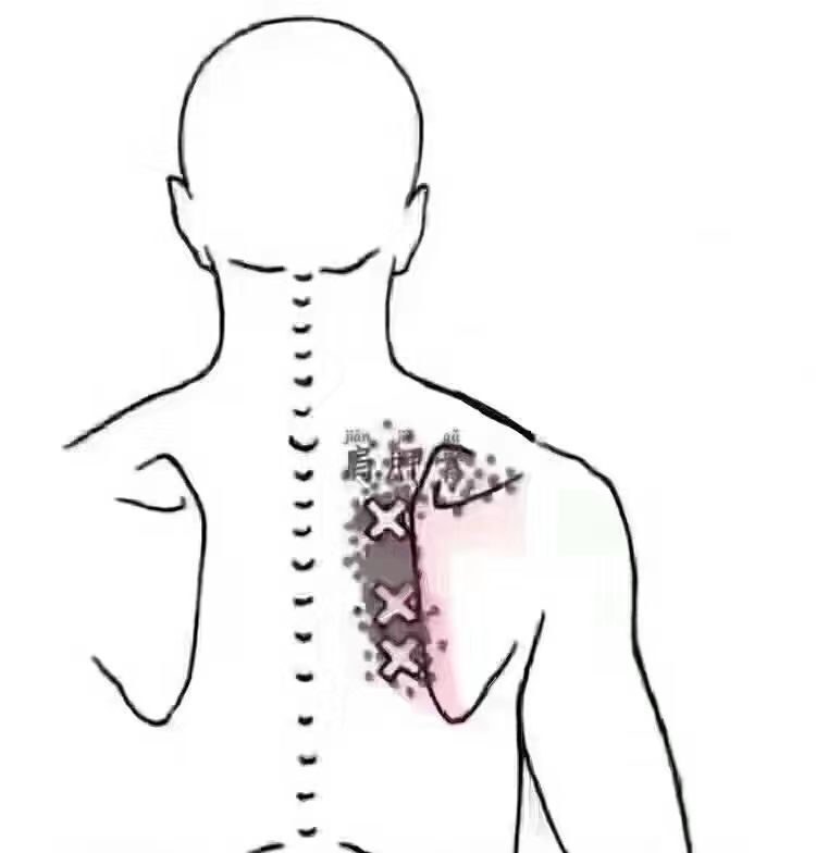 肩胛骨疼痛的鉴别方法