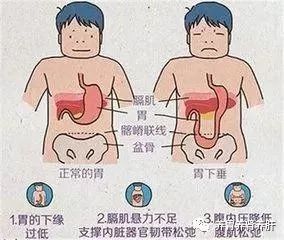 胃病是指胃炎和十二指肠溃疡病?医生:有一种胃病在此范围外