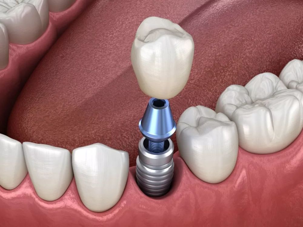 种植牙的牙冠就是我们所种植的牙,它多有以下三种材料: 金属冠:金属