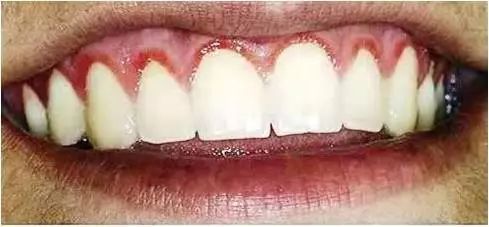 好发于腭部和牙龈,呈单个或多个褐色,红色,蓝