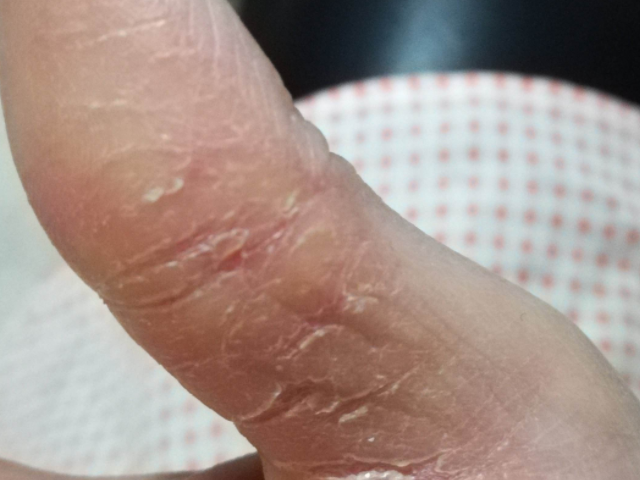 当患有干燥性皮炎时会引起手指脱皮,早期患者皮肤上出现丘疹和水泡