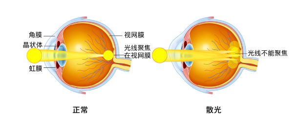 科普 近视和散光的区别