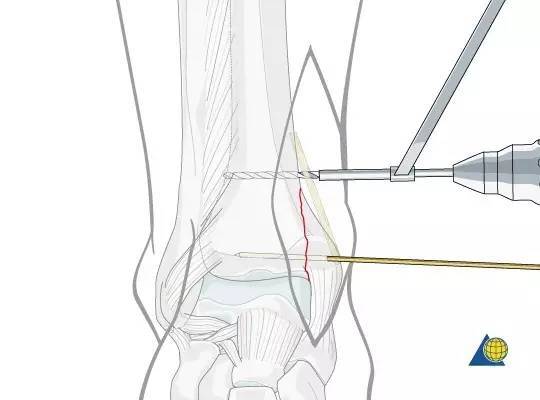 骨科小技巧内踝垂直型骨折的手术技巧