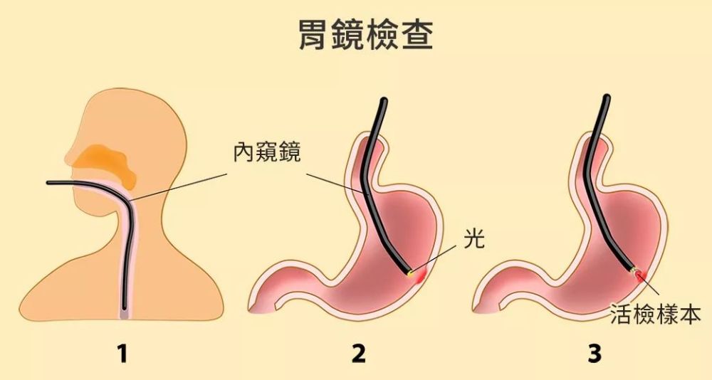 做胃镜检查的同时,还能做哪些检查?