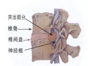 腰肌劳损vs腰椎间盘突出,你分得清?裕国香菇脆图片