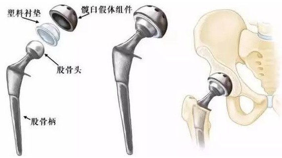 名医专访航天中心医院陈晶髋关节保头与置换