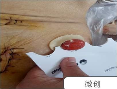你了解造口并发症吗?你知道简单的处理方法吗?