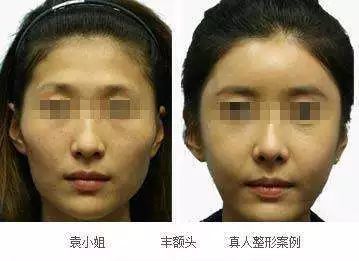 先来看看比较普适的情况,额头凹陷大家一般想到的是垫额头.