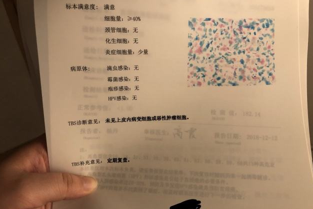 hpv16阳性后,宫颈病变之前,有5个信号提示,要注意了