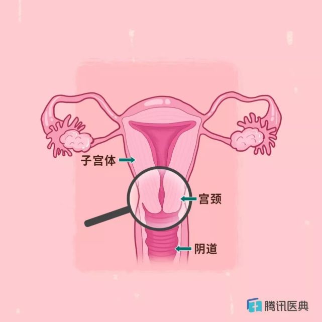 宫颈柱状上皮异位|宫颈|宫颈管颈癌