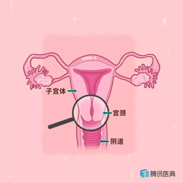 被污名化的"宫颈糜烂",多少中国女人受它折磨!