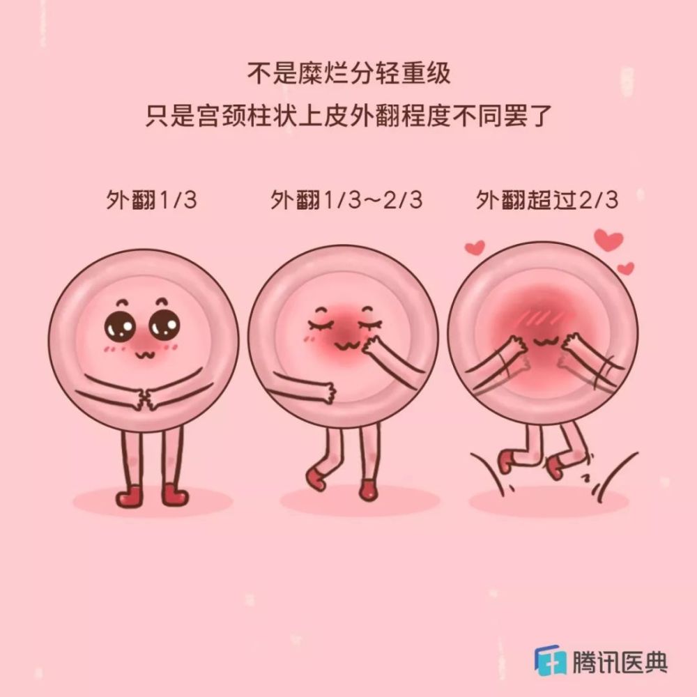 不是病!被污名化的"宫颈糜烂",多少中国女人受它折磨!