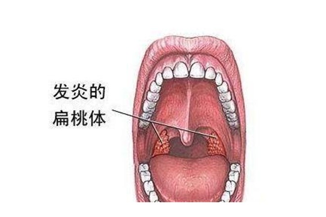 你知道扁桃体有什么作用吗?为什么会反复发炎?