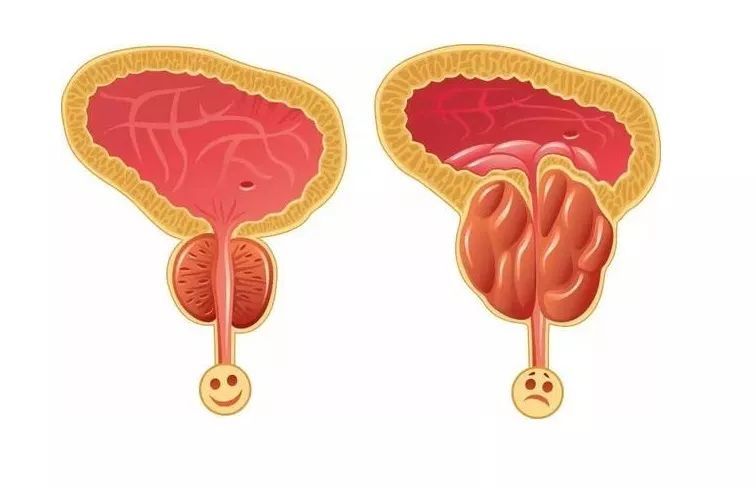 得了前列腺增生,什么情况下需要用药?建议中老年男性都看看