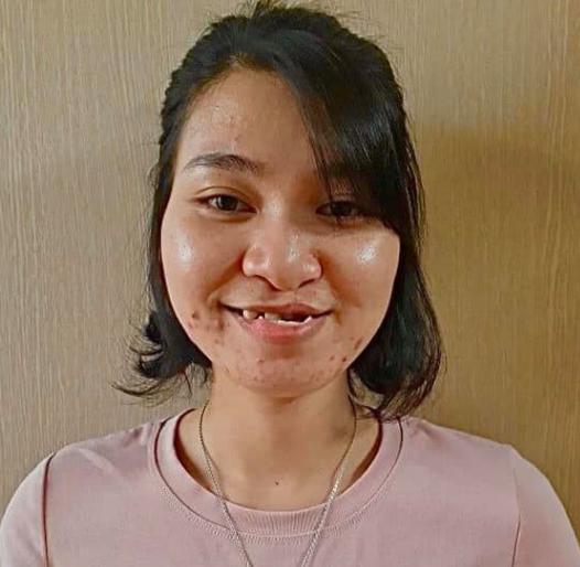 兔唇女孩因相貌丑陋生活艰难,参加节目整容,判若两人母亲都没认出来