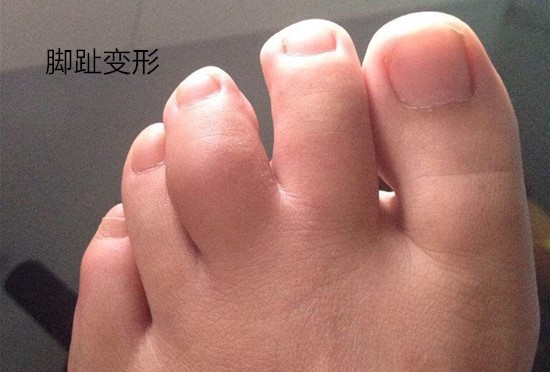5岁宝宝脚趾变形,只因家长总是给他穿这种鞋子,别舍不