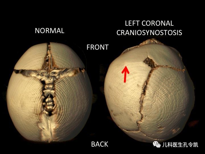 宝宝囟门闭合早晚问题不大但颅缝闭合早了不行哦