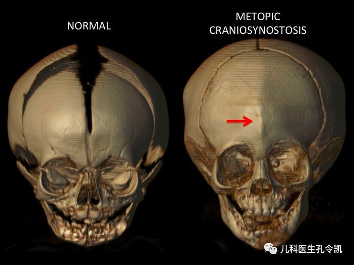 宝宝囟门闭合早晚问题不大但颅缝闭合早了不行哦