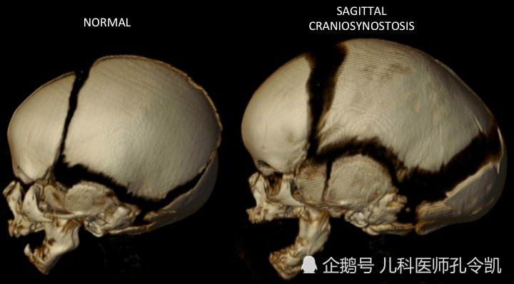 宝宝囟门闭合早晚问题不大,但颅缝闭合早了不行哦