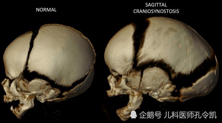 再看下排名第二的冠状缝早闭(coronal craniosynostosis),正好和矢状