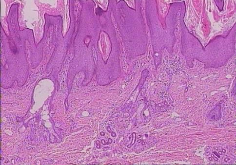 图3 皮脂腺痣 表皮疣状增生,可见畸形的毛囊和皮脂腺治疗:因为影响